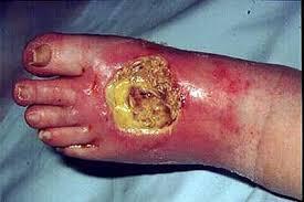 Lesión avanzada en el dorso del pie