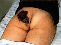 Mordedura con necrosis en región glútea