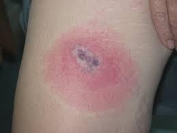 Mordedura reciente en muslo