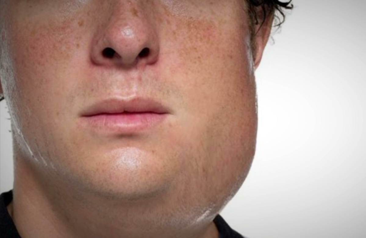 Prevención paperas 1 paperas